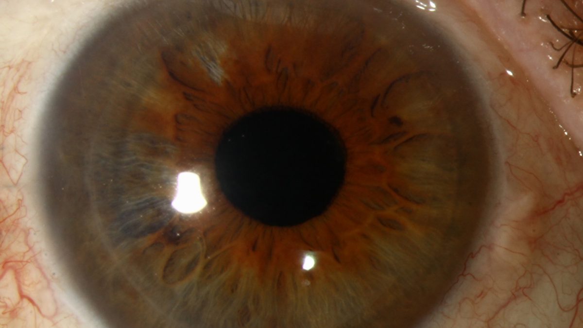 DSEK corneal transplant